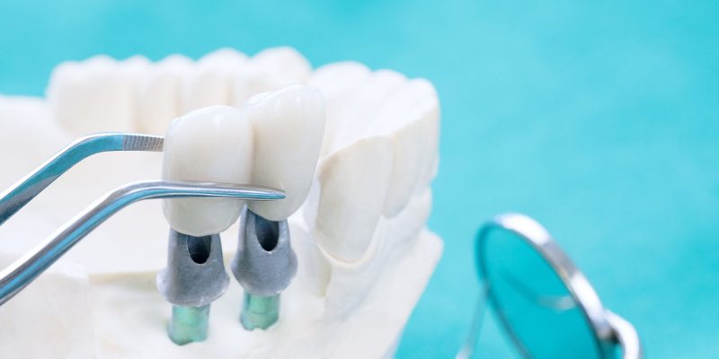 Couse up Implan model tooth support fix bridge implan and crown.