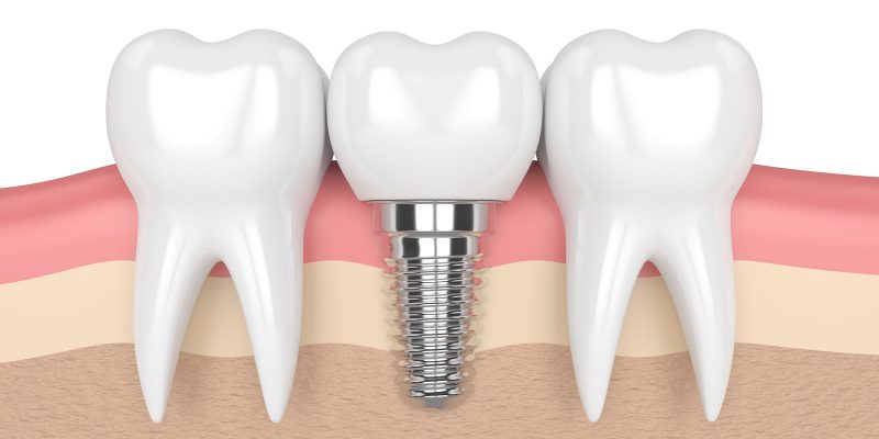 3d render of teeth with dental implant in gums over white background